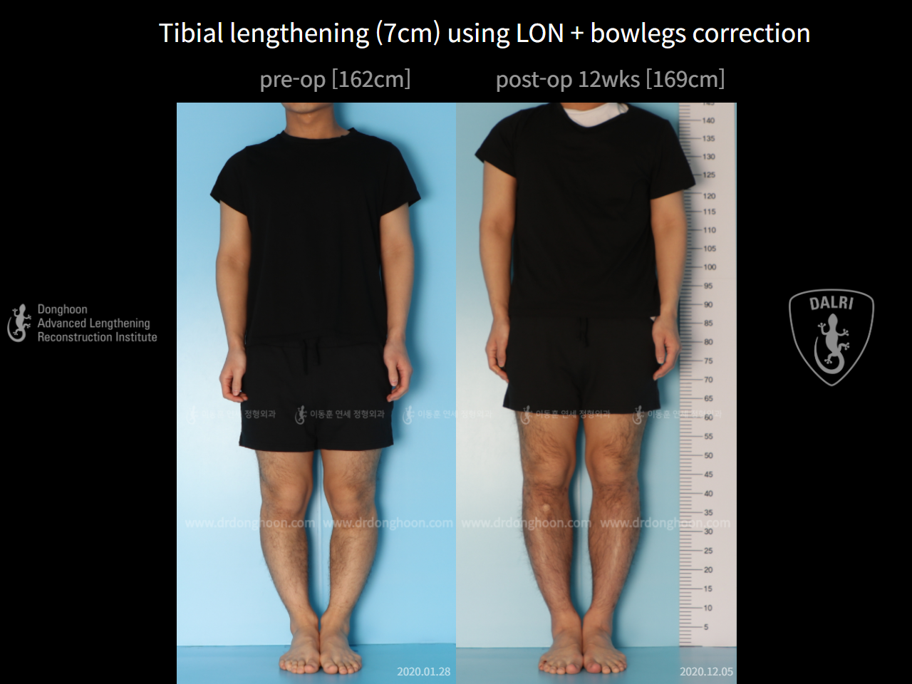Before and after cll + deformity correction, case 6740433, image 2, Dr. Donghoon institute (DALRI)
