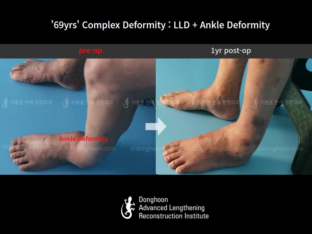 Before and after adult lld, case 8981713, image 5, Dr. Donghoon institute (DALRI)