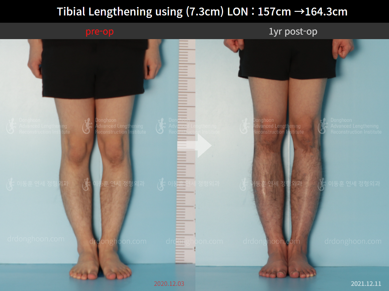 Before and after cll lon, case 9114235, image 5, Dr. Donghoon institute (DALRI)