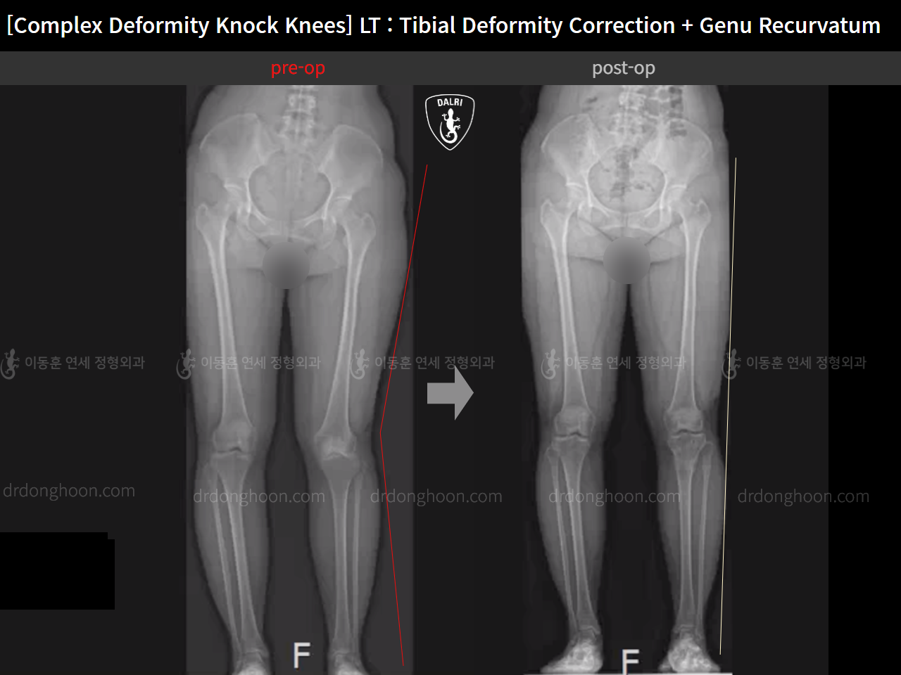 Before and after adult knock knees, case 15801553, image 3, Dr. Donghoon institute (DALRI)