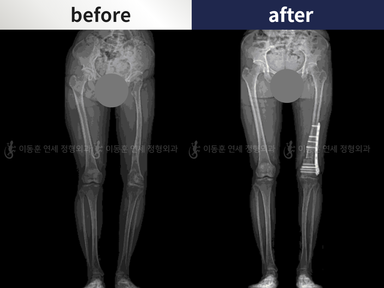 Before and after adult bowlegs, case 5987521, image 4, Dr. Donghoon institute (DALRI)