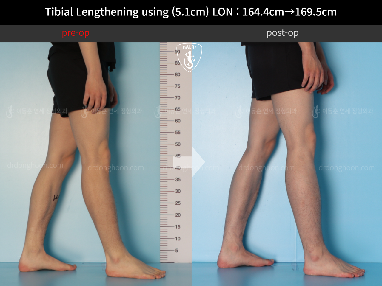 Before and after cll lon, case 12653375, image 7, Dr. Donghoon institute (DALRI)