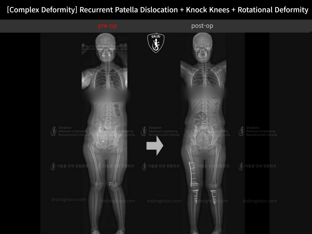 Before and after complex deformity, case 14344403, image 7, Dr. Donghoon institute (DALRI)