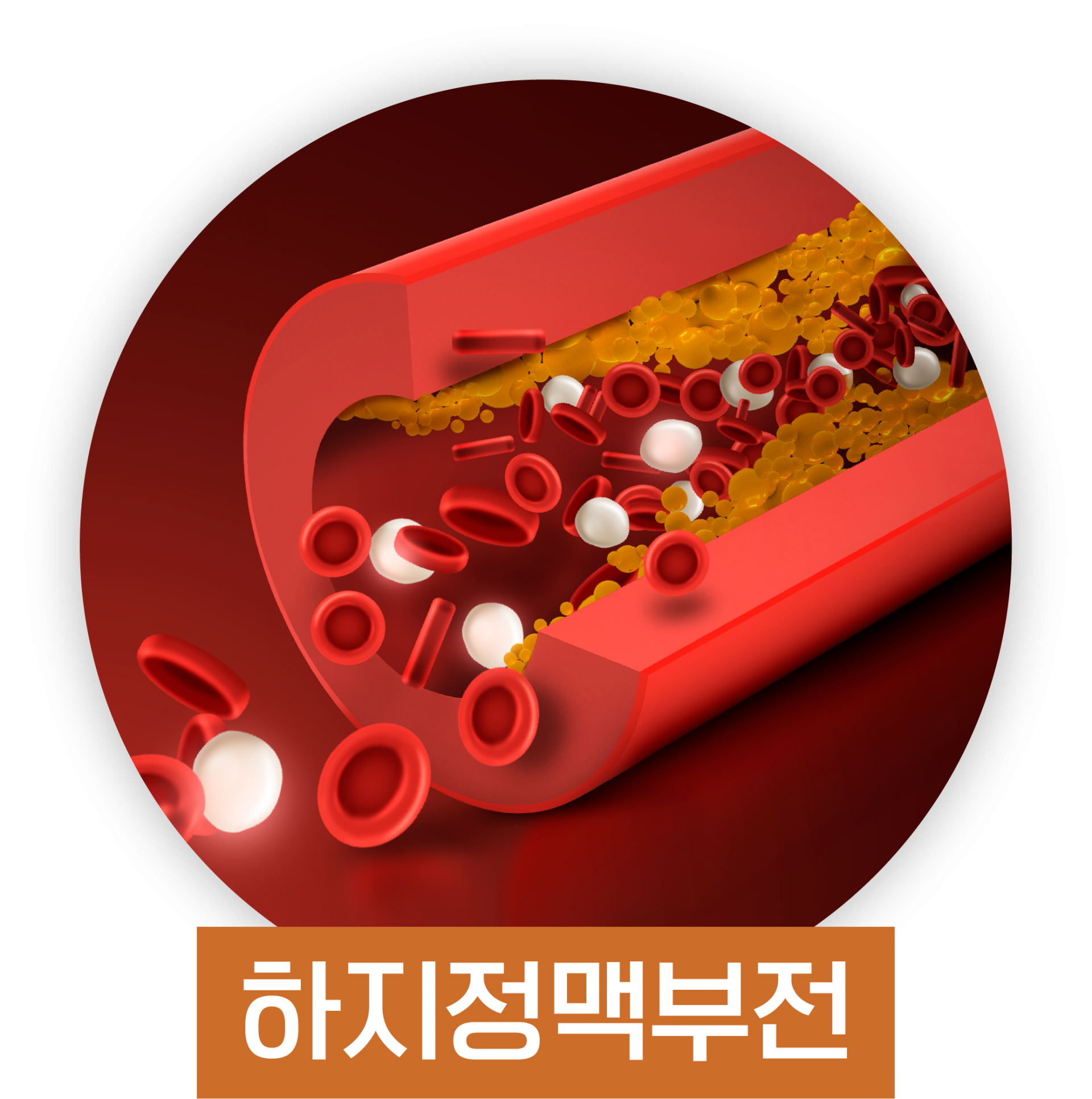 하지정맥부전