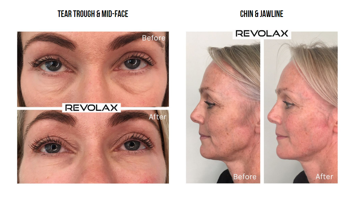 REVOLAX Before and After Transformations - REVOLAX UK