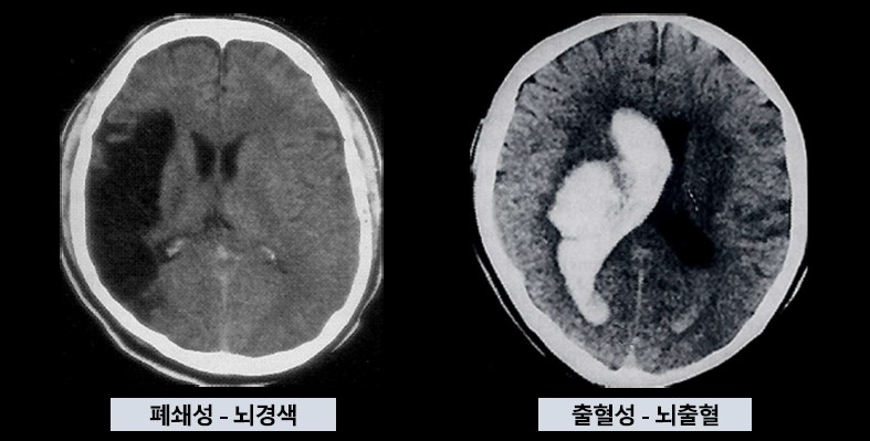 뇌경색과 뇌출혈