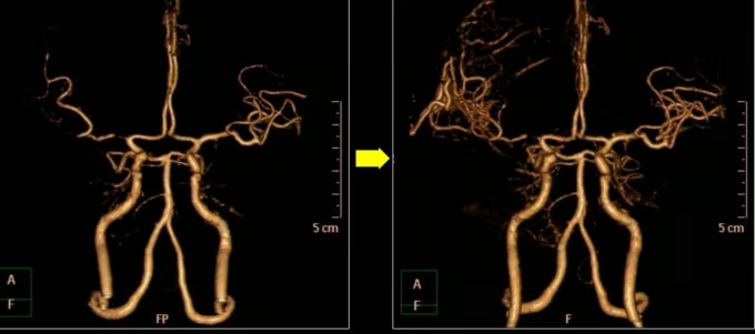 (사진 왼쪽부터) 막힌 뇌 혈관의 '우회로'를 뚫는 뇌혈관 문합술 전과 후 모습. /사진=에스포항병원