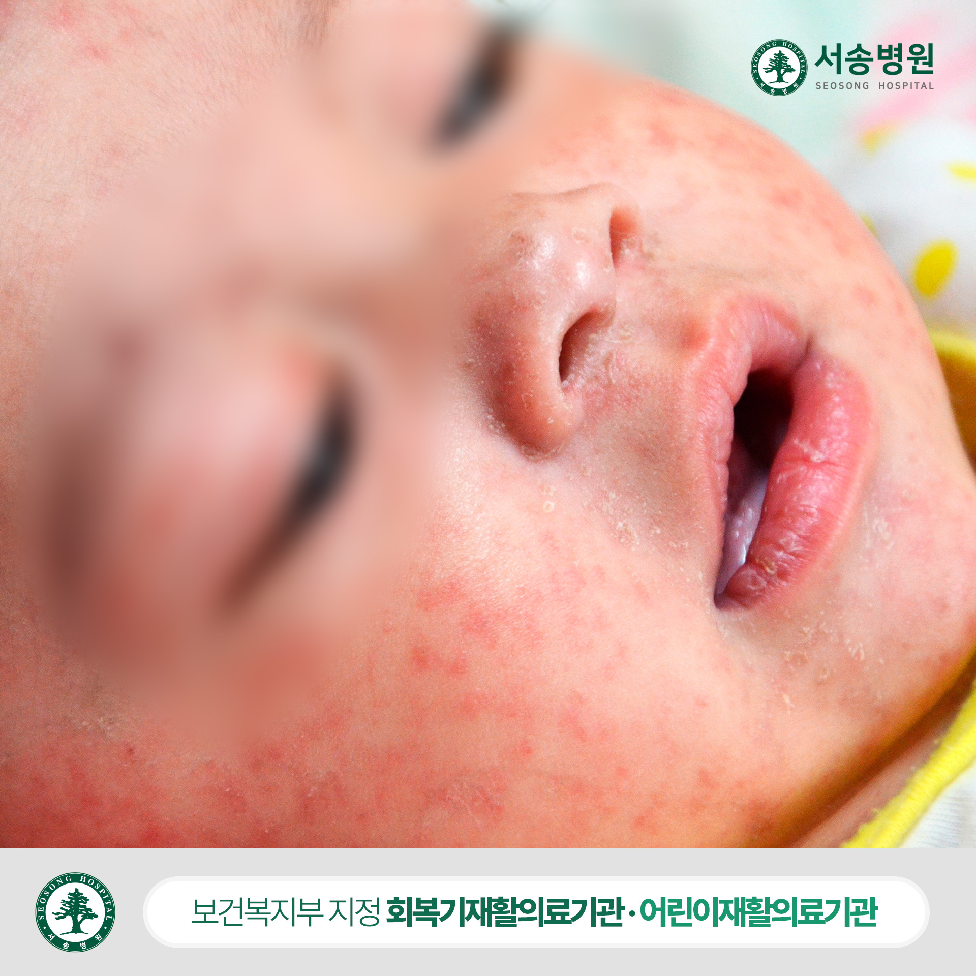 소아홍역증상