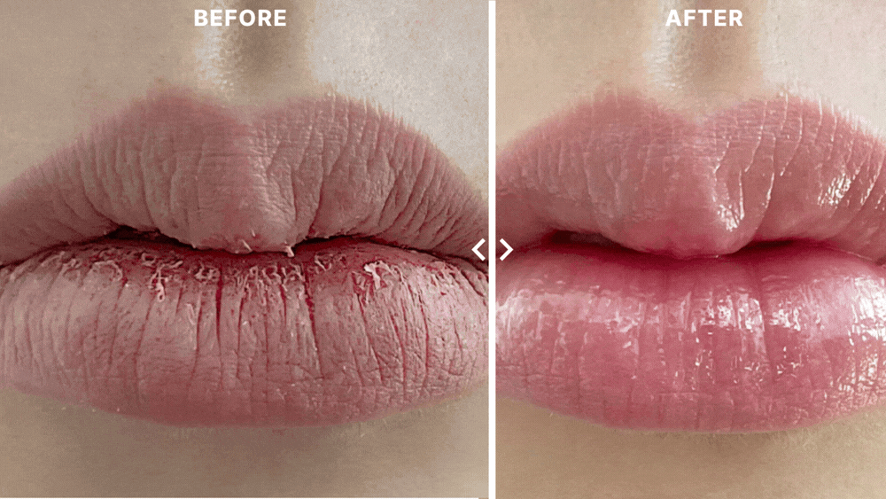 입술 각질과 건조함이 개선되고 윤기 있는 플럼핑 입술로 변화된 립케어 before after