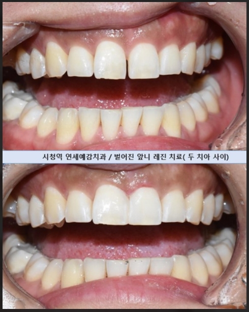 앞니레진치료4.jpeg
