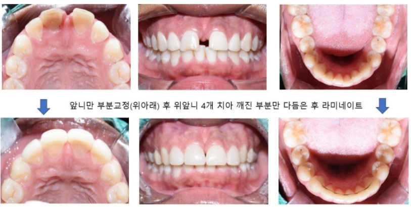 앞니레진치료10.jpeg