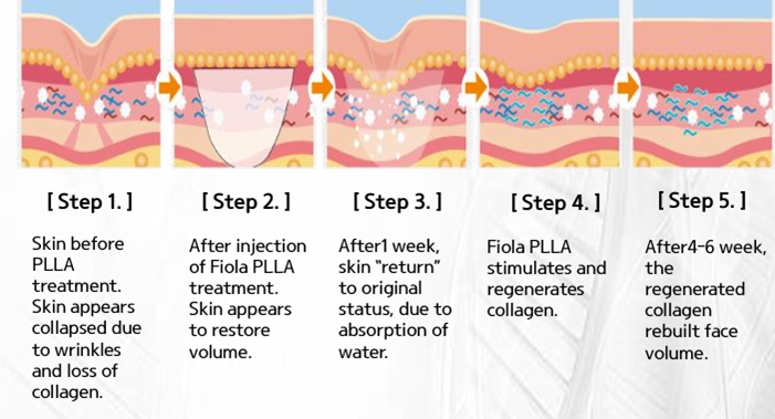 FIOLA PLLA: The Innovation of PLLA Collagen Fillers : Medi-fella | Blog