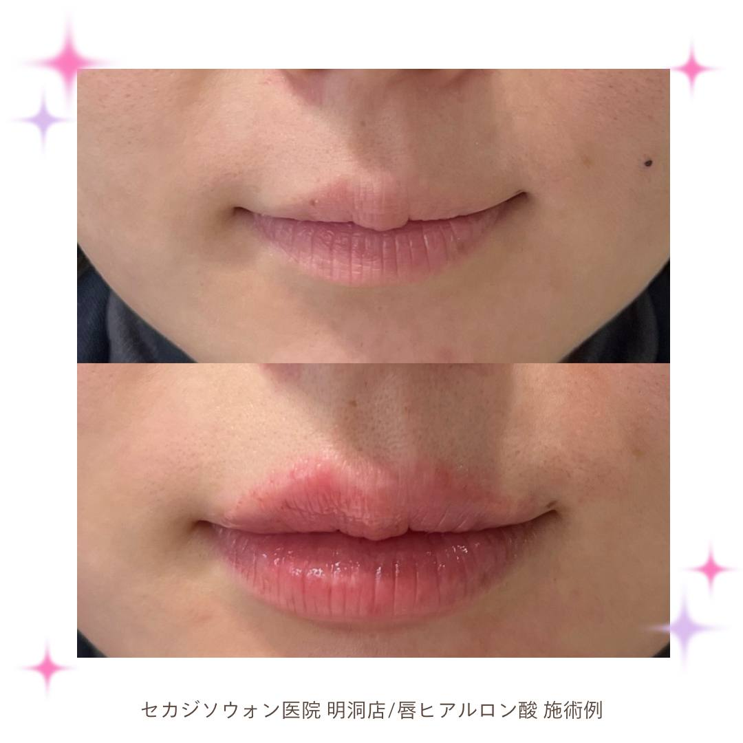 唇フィラーおすすめ！唇が変わります♡ : TWスタッフ日記