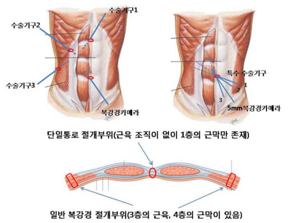 단일통로 vs 일반 복강경 비교