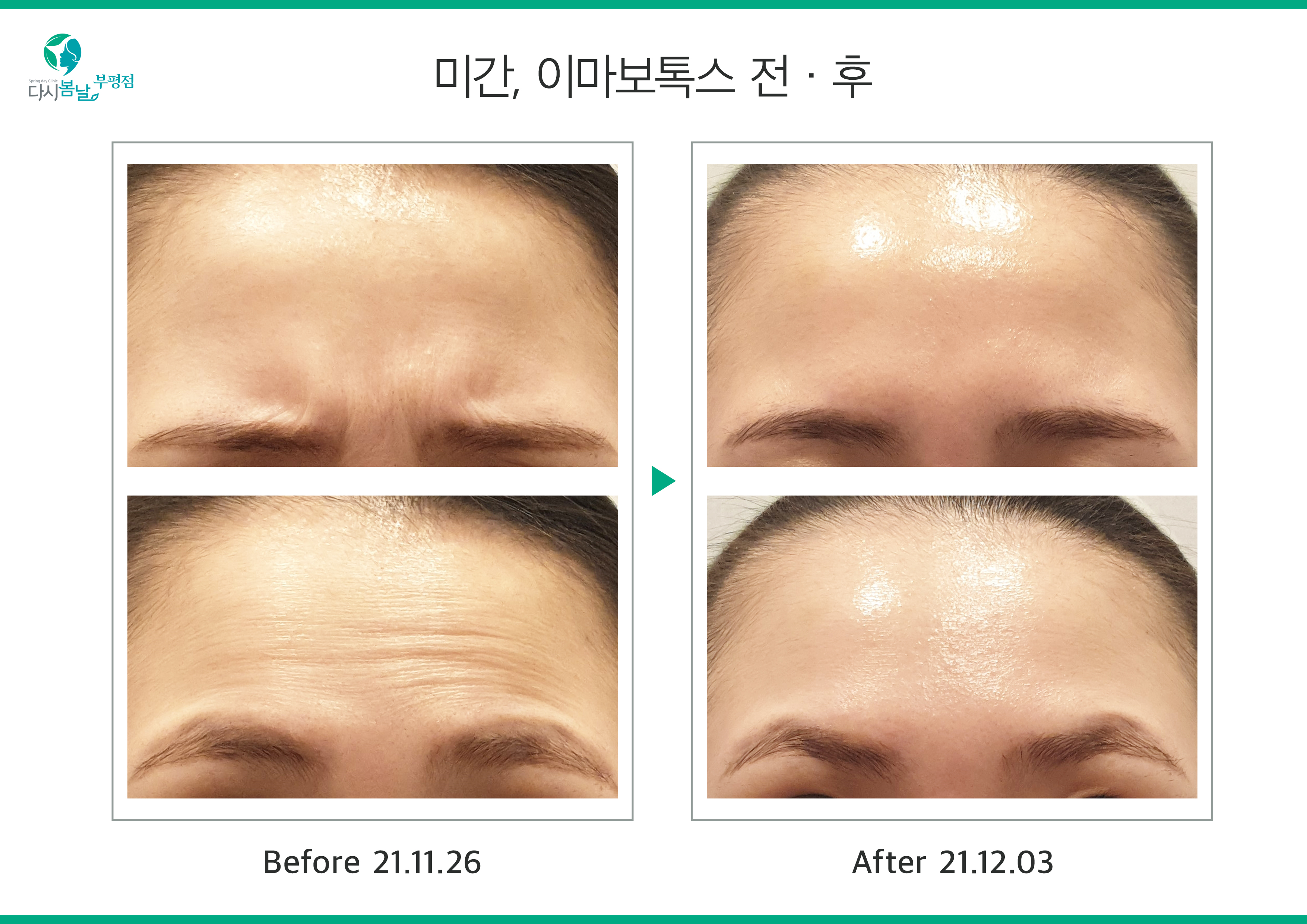 [보톡스] 미간, 이마보톡스 시술 전/후 : 다시봄날의원 부평점
