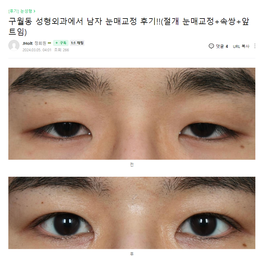 구월동 성형외과에서 남자 눈매교정 후기!!(절개 눈매교정+속쌍+앞트임) : 고객후기