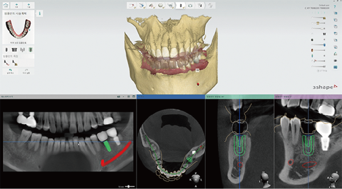 디지털 임플란트