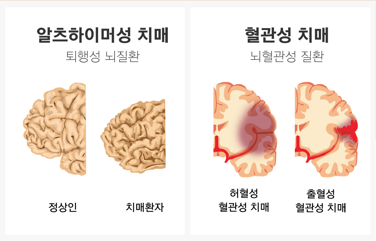 진료과목_치매치료