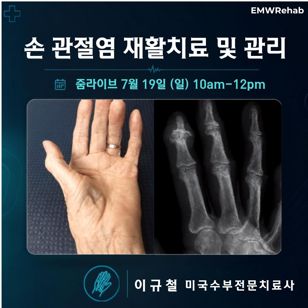 손 관절염 재활치료 및 관리
