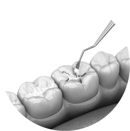 남천동-광안리치과-유엘치과-충치치료-레진치료