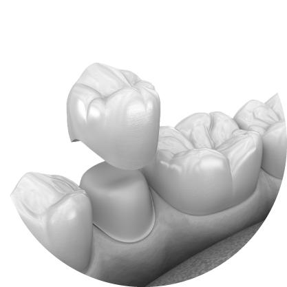 남천동-광안리치과-유엘치과-충치치료-크라운치료