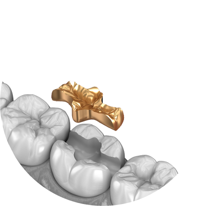 남천동-광안리치과-유엘치과-충치치료-인레이치료-금