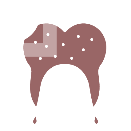 남천동-광안리치과-유엘치과-신경치료-감염된치수확인