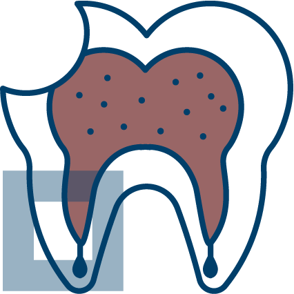남천동-광안리치과-유엘치과-충치치료-뿌리충치
