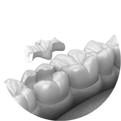 남천동-광안리치과-유엘치과-충치치료-인레이치료-세라믹