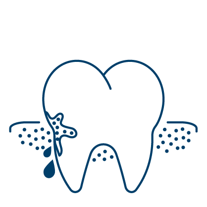 남천동-광안리치과-유엘치과-잇몸치료-잇몸뼈녹음