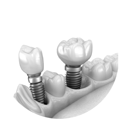 남천동-광안리치과-유엘치과-충치치료-임플란트치료