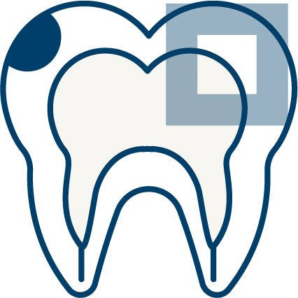 남천동-광안리치과-유엘치과-충치치료-표면충치