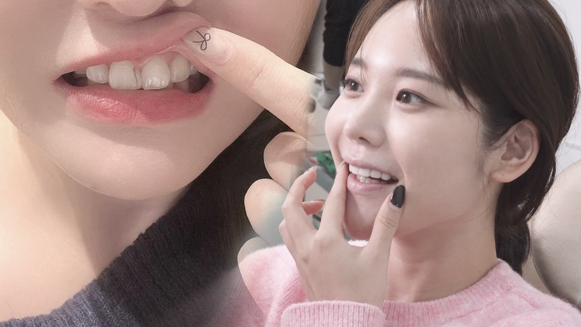 앞니 레진을 폴리네이트로