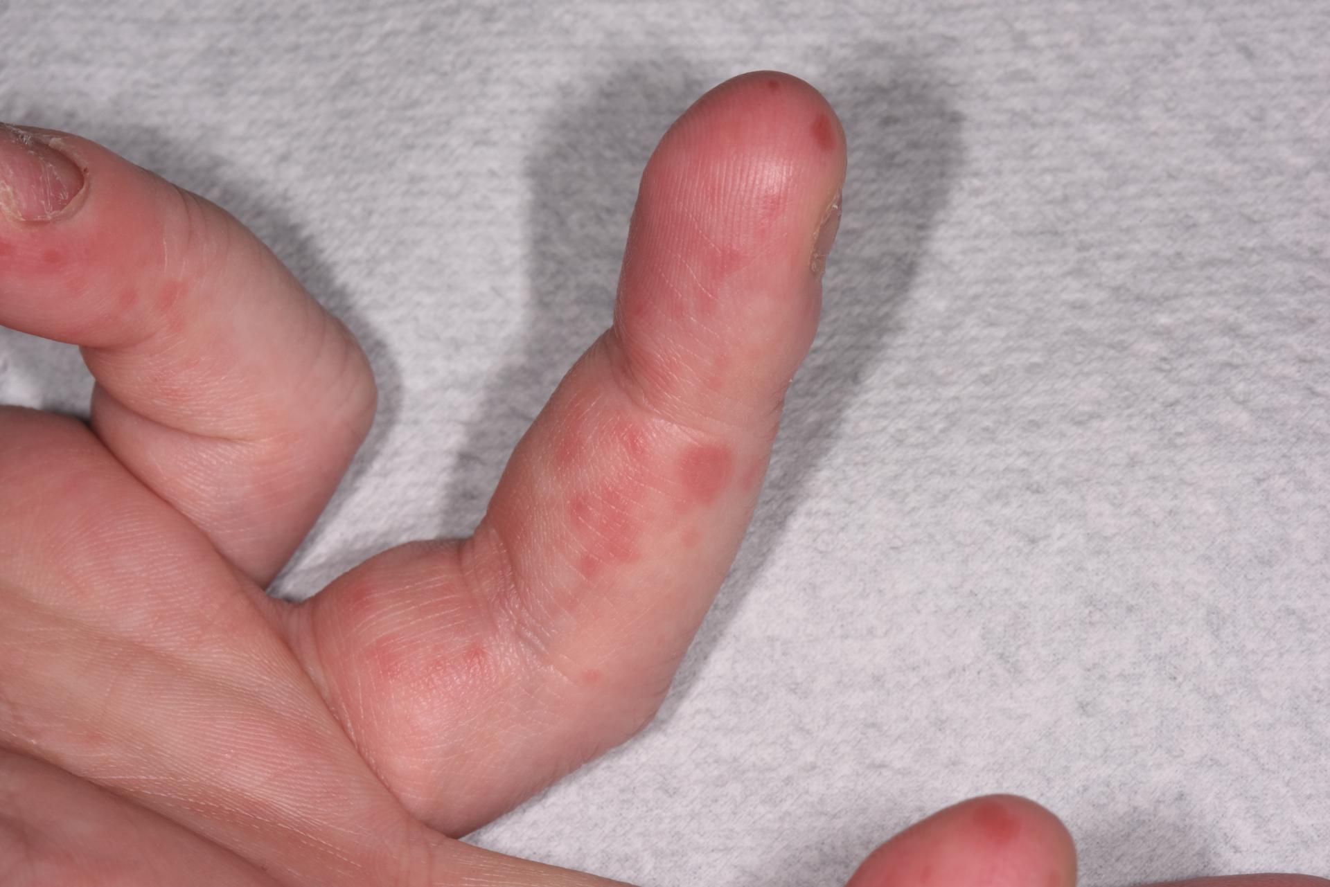 수족구 손 사진