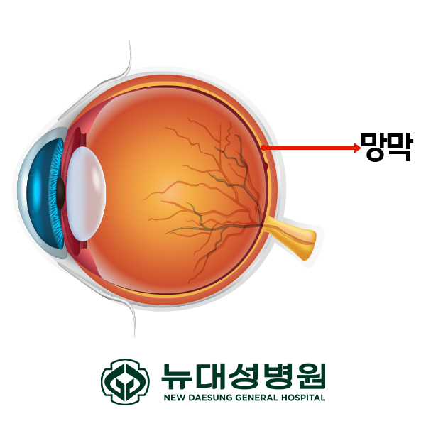 당뇨합병증 망막