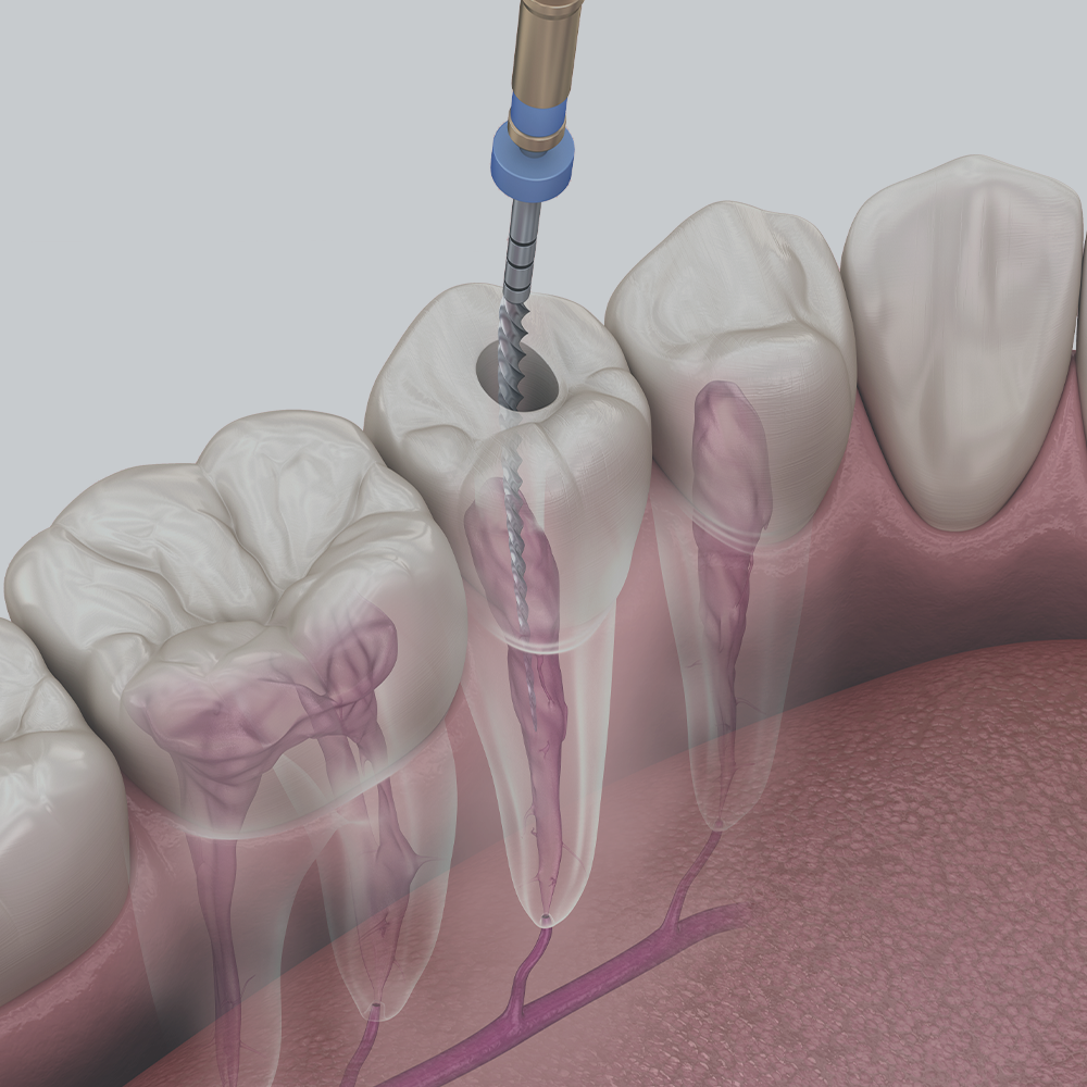 시흥치과 신경치료