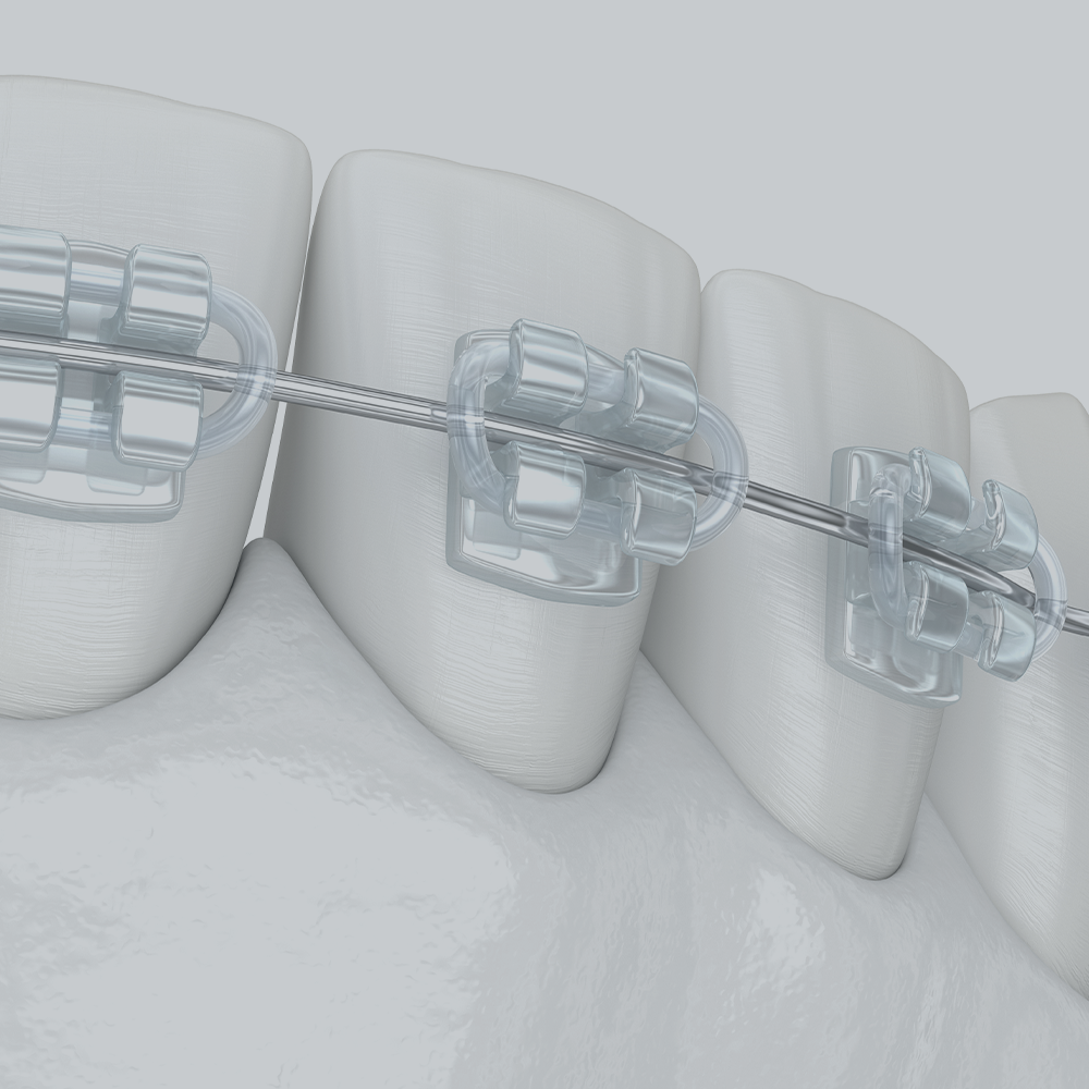 시흥치과 치아교정