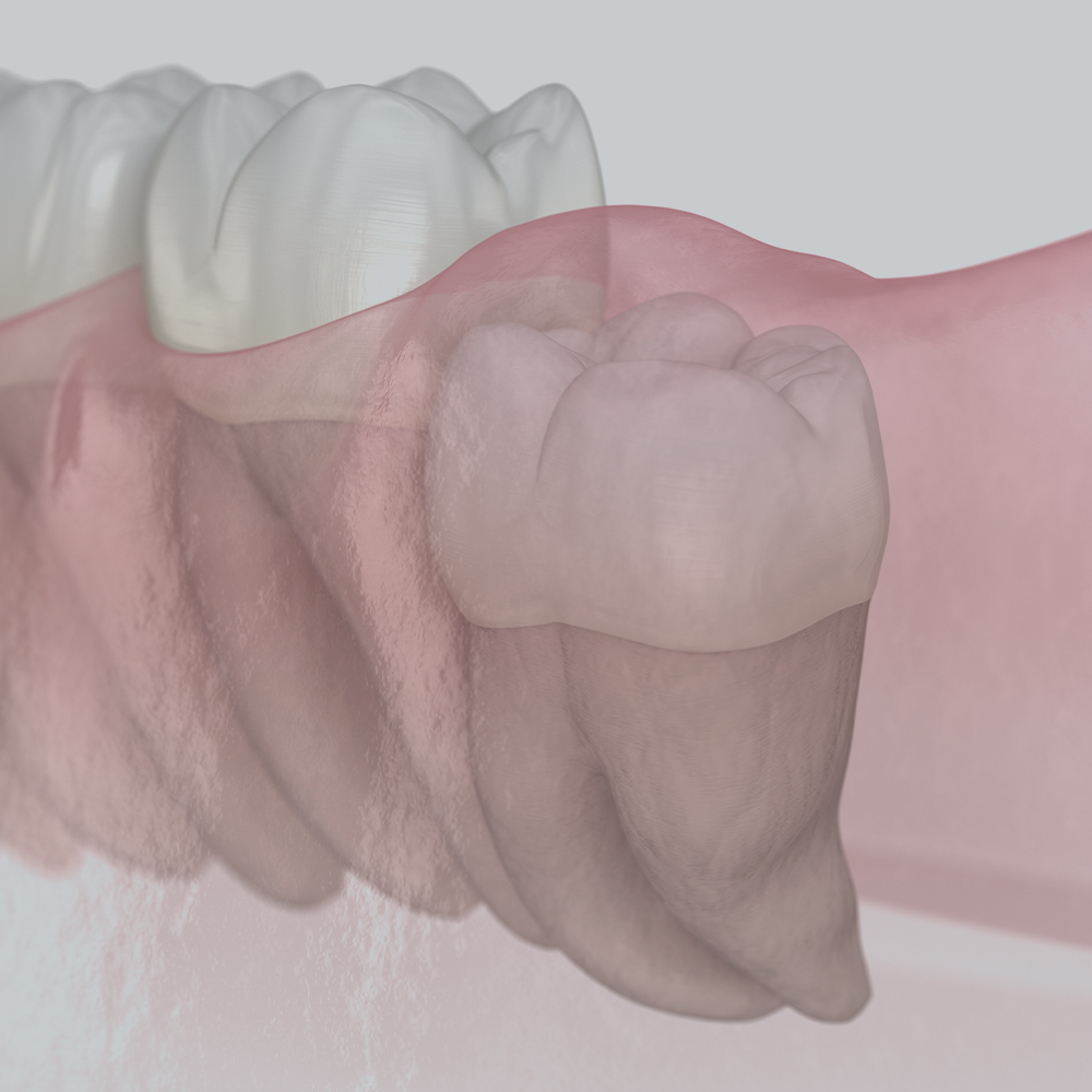 시흥치과 사랑니