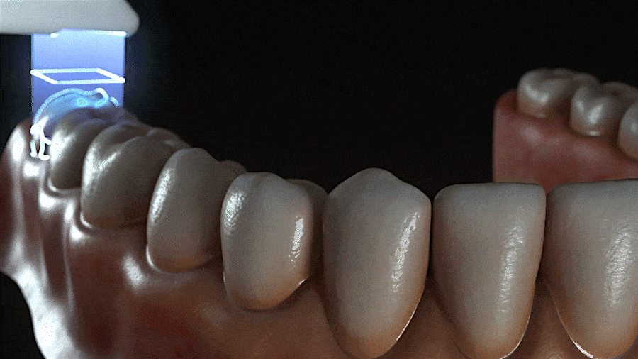 시흥치과 임플란트