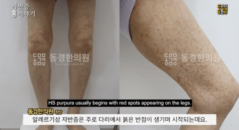 알레르기성 자반증 치료 및 주의해야할 음식 : 난치성 피부질환|칼럼