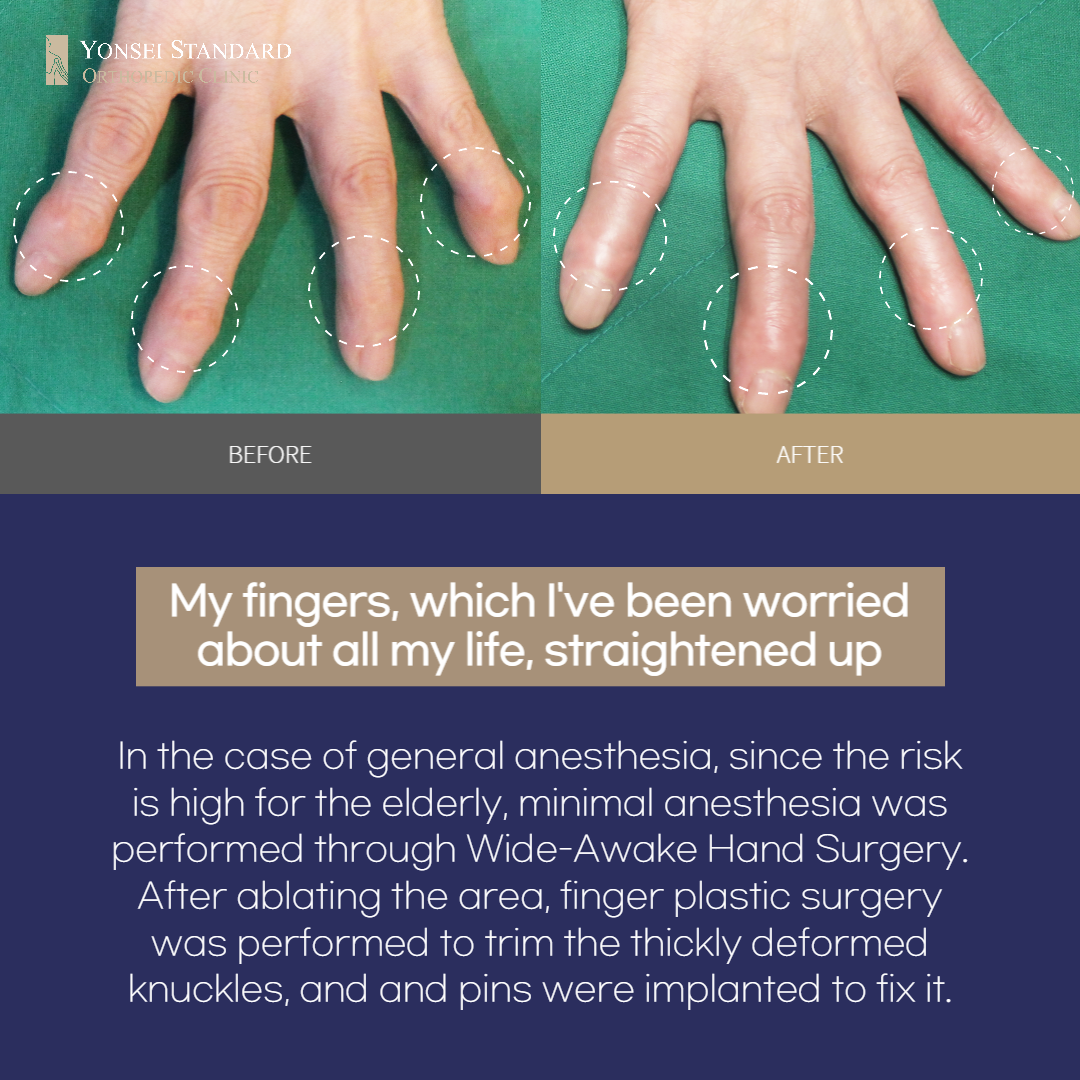 Why should I have finger arthritis surgery at YONSEI STANDARD