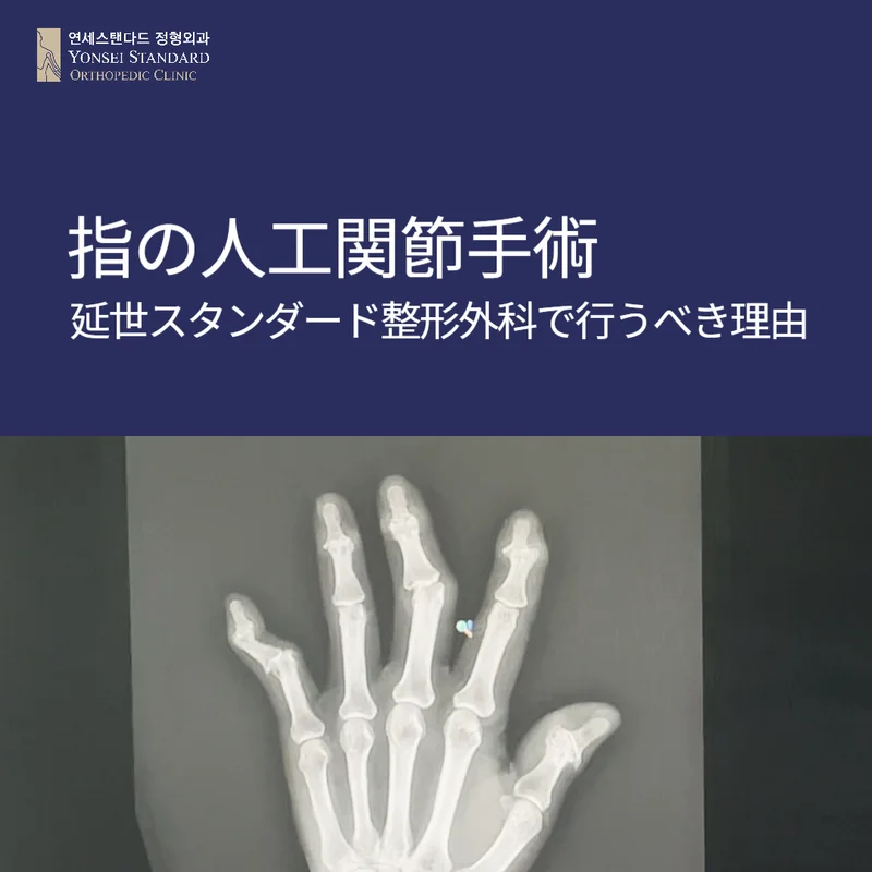 指の人工関節手術が可能な韓国の整形外科 : 연세스탠다정형외과 Yonsei