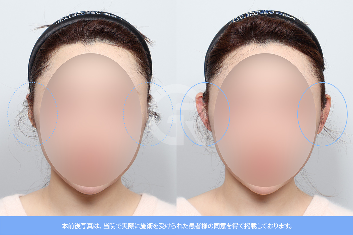 耳の解剖構造である耳輪と対耳輪は耳の形を決める重要な要素です。