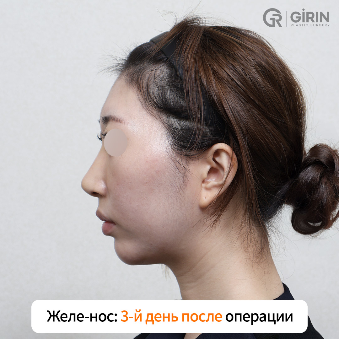 Процесс забора ушного хряща — без видимых следов на ух