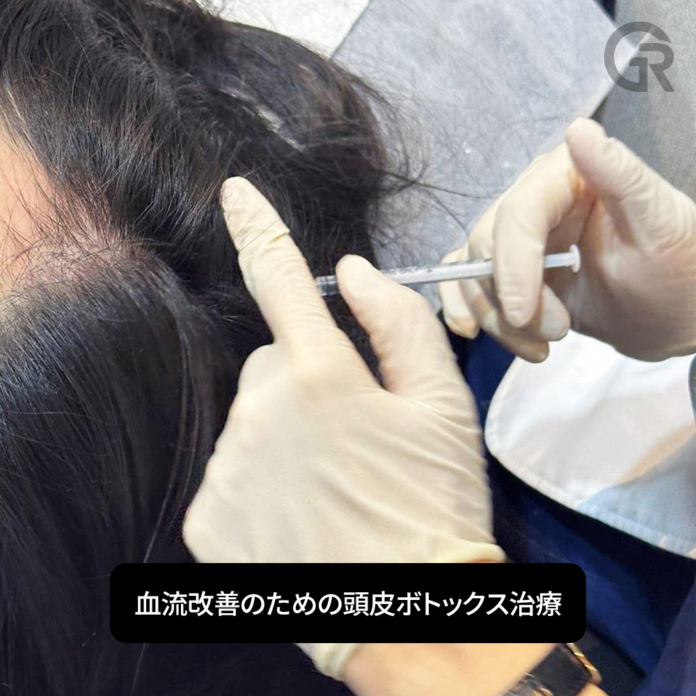 血流改善を目的とした頭皮ボトックス