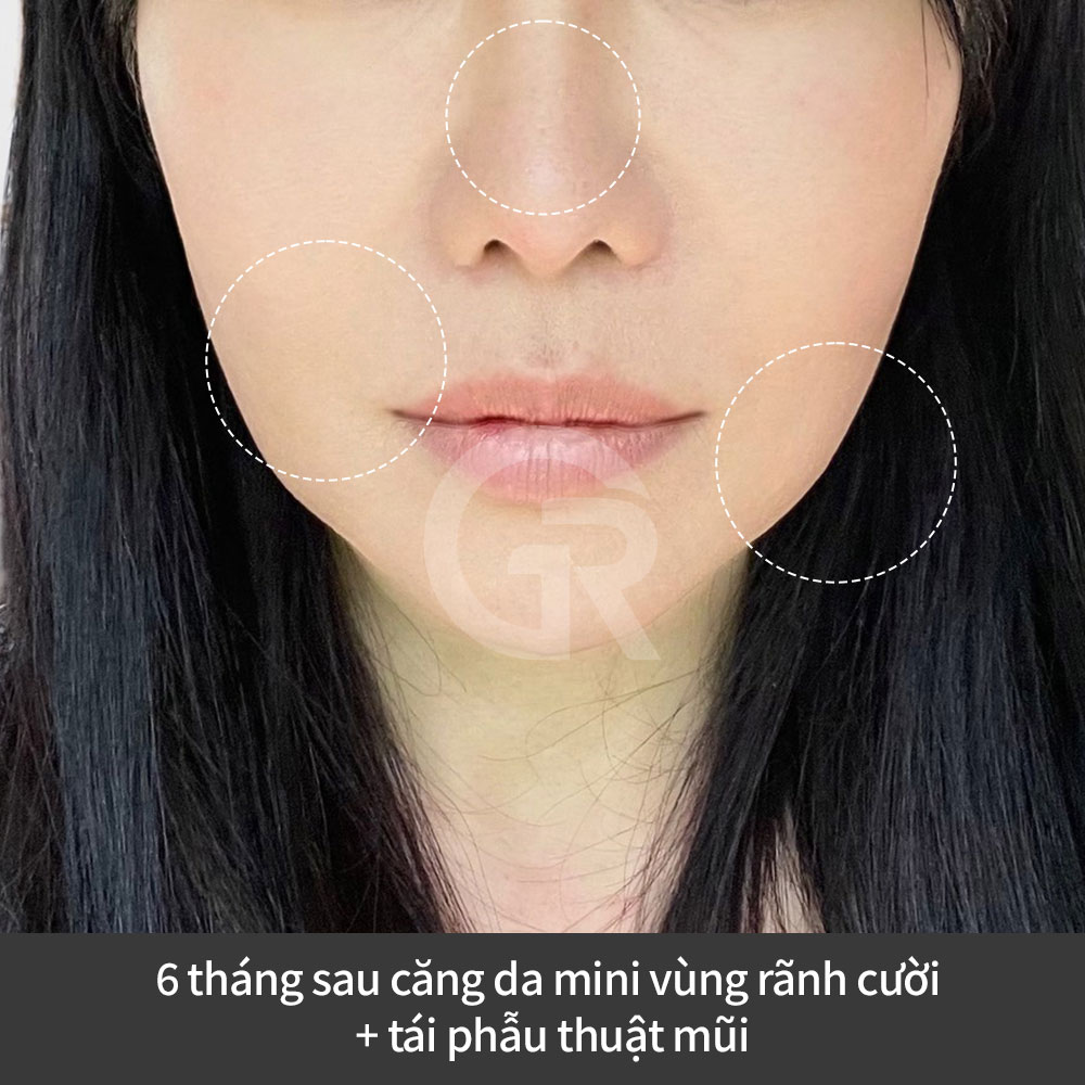 Kết quả chống lão hóa tự nhiên tại Bệnh viện thẩm mỹ Girin Hàn Quốc, không hướng đến thay đổi quá mức mà tập trung vào sự cân đối của khuôn mặt.