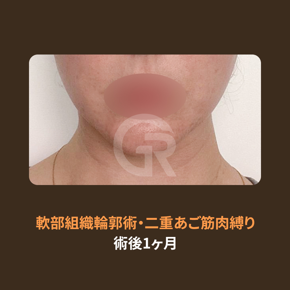 二重あごや顔のたるみが気になる場合は、見た目だけで判断せず、構造的な原因まで確認することが大切です。