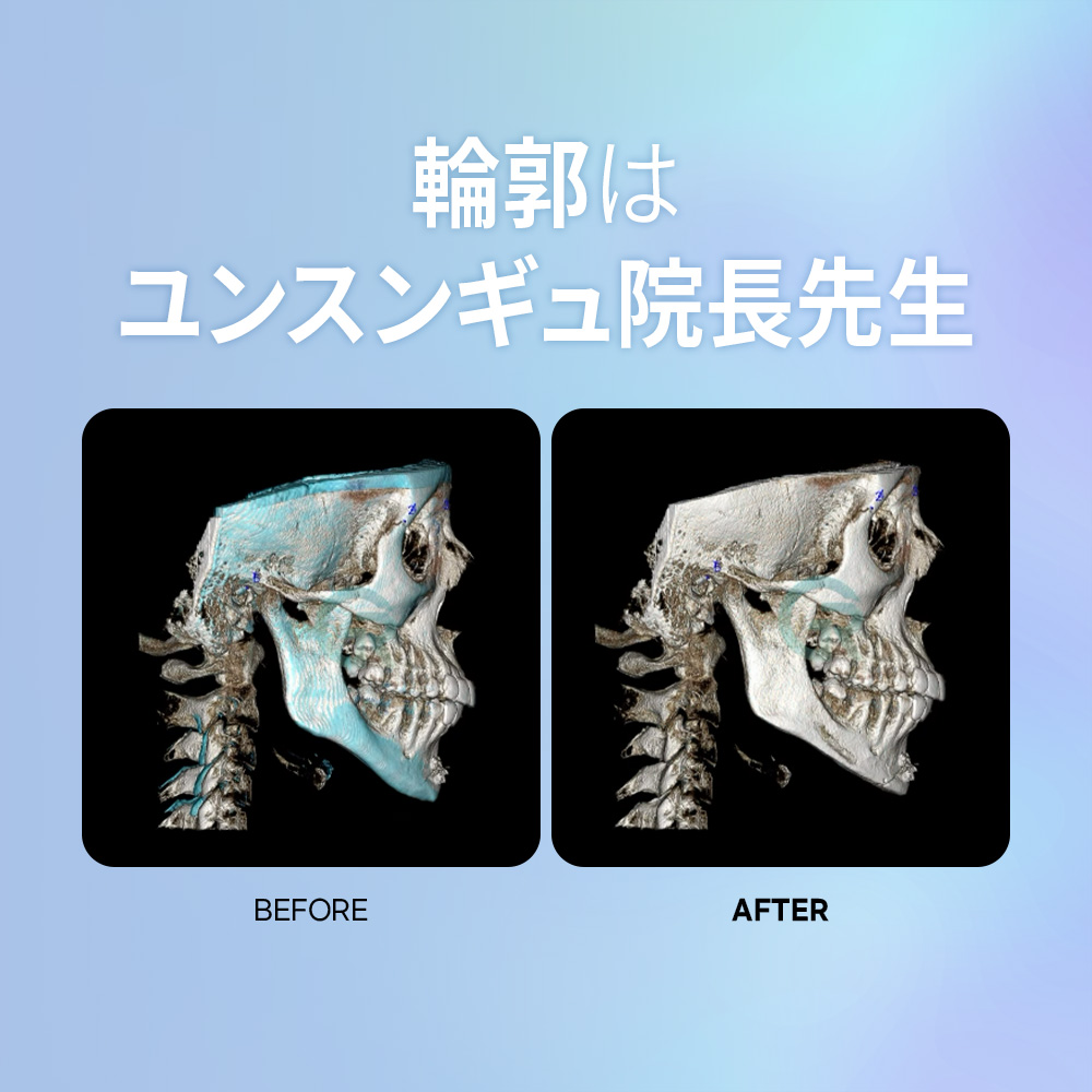 精密な骨削りで理想のVラインを実現。