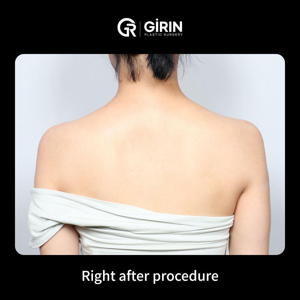 Achieve a perfect 90-degree shoulder angle without surgery