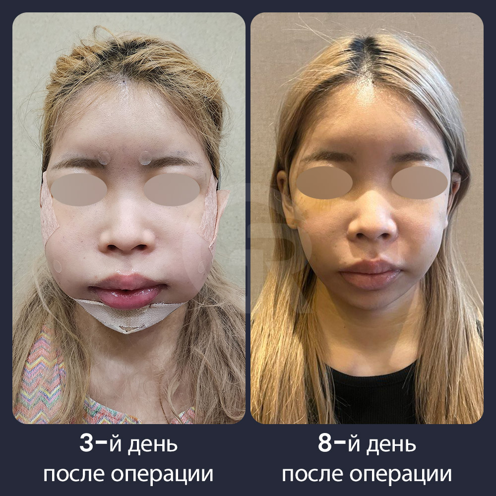 Контурная пластика лица в Girin Plastic Surgery в Корее направлена на создание сбалансированных пропорций в рамках собственной структуры лица пациента, а не на чрезмерное уменьшение кости.
